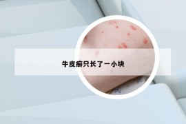 牛皮癬只長了一小塊