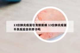 13價(jià)肺炎疫苗引發(fā)銀屑病 13價(jià)肺炎疫苗不良反應(yīng)會(huì)長(zhǎng)疹子嗎