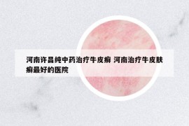 河南許昌純中藥治療牛皮癬 河南治療牛皮膚癬最好的醫(yī)院