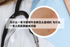 為什么一家子都得牛皮癬怎么造成的 為什么一家人的皮膚都有問題