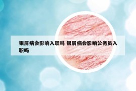 銀屑病會影響入職嗎 銀屑病會影響公務(wù)員入職嗎
