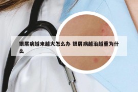 銀屑病越來越大怎么辦 銀屑病越治越重為什么