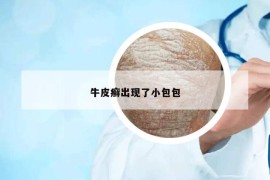 牛皮癬出現(xiàn)了小包包