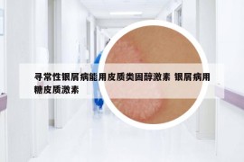 尋常性銀屑病能用皮質(zhì)類固醇激素 銀屑病用糖皮質(zhì)激素