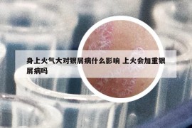 身上火氣大對銀屑病什么影響 上火會加重銀屑病嗎