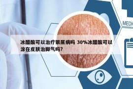 冰醋酸可以治療銀屑病嗎 30%冰醋酸可以涂在皮膚治腳氣嗎?