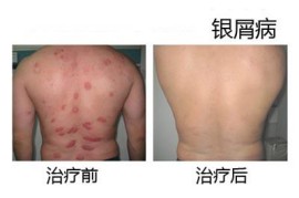 銀屑病生物制劑的優(yōu)缺點(diǎn)有哪些