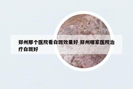 鄭州那個(gè)醫(yī)院看白斑效果好 鄭州哪家醫(yī)院治療白斑好