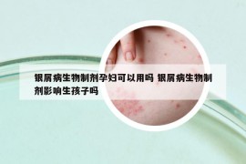 銀屑病生物制劑孕婦可以用嗎 銀屑病生物制劑影響生孩子嗎