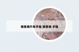 銀屑病只有手指 銀屑病 手指