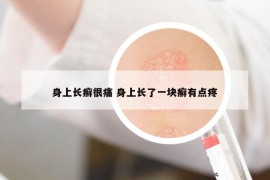身上長(zhǎng)癬很痛 身上長(zhǎng)了一塊癬有點(diǎn)疼