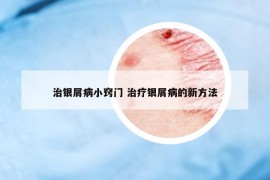 治銀屑病小竅門 治療銀屑病的新方法