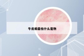牛皮癬最怕什么是物