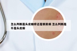 怎么判斷是頭皮糠疹還是銀屑病 怎么判斷是不是頭皮癬