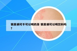 銀屑病可不可以喝奶茶 銀屑病可以喝飲料嗎?