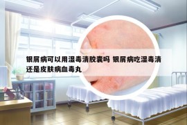 銀屑病可以用濕毒清膠囊嗎 銀屑病吃濕毒清還是皮膚病血毒丸