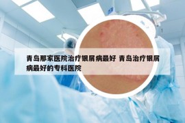 青島那家醫(yī)院治療銀屑病最好 青島治療銀屑病最好的專科醫(yī)院