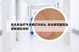 包頭有治療牛皮癬打針的么 包頭哪家醫(yī)院治皮膚病比較好