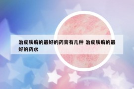 治皮膚癬的最好的藥膏有幾種 治皮膚癬的最好的藥水