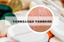 牛皮膚癬怎么引起的 牛皮膚癬的誘因