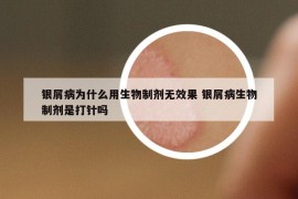 銀屑病為什么用生物制劑無效果 銀屑病生物制劑是打針嗎