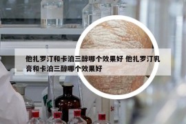 他扎羅汀和卡泊三醇哪個效果好 他扎羅汀乳膏和卡泊三醇哪個效果好