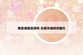 銀屑病是癌癥嗎 白屑風(fēng)病癥狀圖片