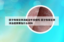 鴿子和綠豆煲湯能治牛皮癬嗎 鴿子和綠豆煲湯治痘需要加什么材料