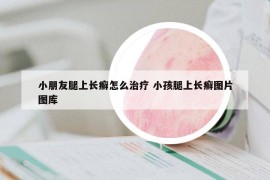 小朋友腿上長(zhǎng)癬怎么治療 小孩腿上長(zhǎng)癬圖片圖庫(kù)