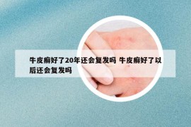 牛皮癬好了20年還會(huì)復(fù)發(fā)嗎 牛皮癬好了以后還會(huì)復(fù)發(fā)嗎