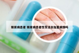 銀屑病患者 銀屑病患者性生活會(huì)加重病情嗎