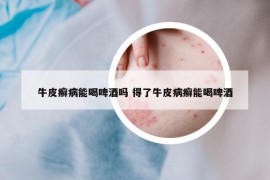 牛皮癬病能喝啤酒嗎 得了牛皮病癬能喝啤酒
