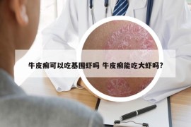 牛皮癬可以吃基圍蝦嗎 牛皮癬能吃大蝦嗎?
