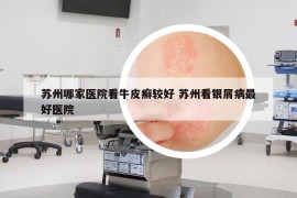 蘇州哪家醫(yī)院看牛皮癬較好 蘇州看銀屑病最好醫(yī)院