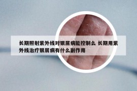 長期照射紫外線對(duì)銀屑病能控制么 長期用紫外線治療銀屑病有什么副作用