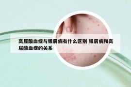 高尿酸血癥與銀屑病有什么區(qū)別 銀屑病和高尿酸血癥的關系