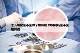 怎么確定是不是得了銀屑病 如何判斷是不是銀屑病