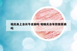 咽炎身上會(huì)長(zhǎng)牛皮癬嗎 咽喉炎會(huì)導(dǎo)致銀屑病嗎