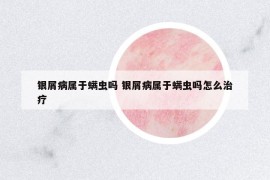 銀屑病屬于螨蟲嗎 銀屑病屬于螨蟲嗎怎么治療