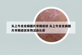 頭上牛皮皮癬圖片早期癥狀 頭上牛皮皮癬圖片早期癥狀食物活血化瘀