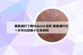 銀屑病打了兩針ak101沒好 銀屑病打針一針可以控制十幾年的嗎
