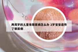 兩周歲的兒童有銀屑病怎么辦 2歲寶寶遺傳了銀屑病