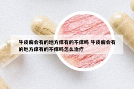 牛皮癬會有的地方癢有的不癢嗎 牛皮癬會有的地方癢有的不癢嗎怎么治療
