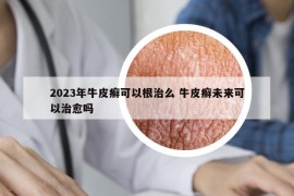 2023年牛皮癬可以根治么 牛皮癬未來(lái)可以治愈嗎