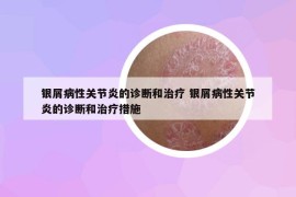 銀屑病性關(guān)節(jié)炎的診斷和治療 銀屑病性關(guān)節(jié)炎的診斷和治療措施