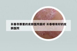 長春市那里的皮膚醫(yī)院最好 長春哪有好的皮膚醫(yī)院