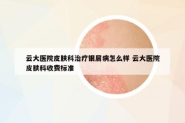 云大醫(yī)院皮膚科治療銀屑病怎么樣 云大醫(yī)院皮膚科收費(fèi)標(biāo)準(zhǔn)