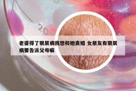 老婆得了銀屑病我想和她離婚 女朋友有銀屑病要告訴父母嘛