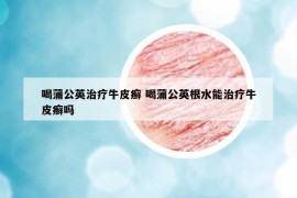 喝蒲公英治療牛皮癬 喝蒲公英根水能治療牛皮癬嗎