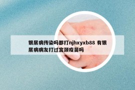 銀屑病傳染嗎都打njhxyxb88 有銀屑病病友打過宮頸疫苗嗎
